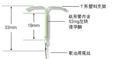 避孕环、节育环、宫内节育器