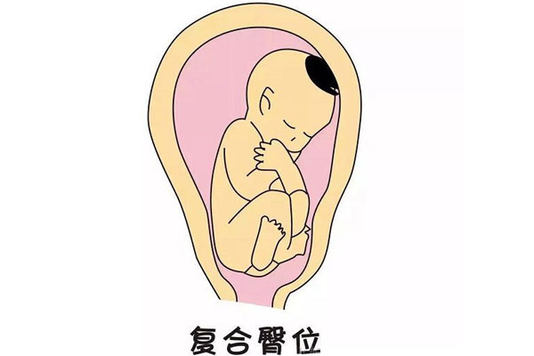 复合臀为