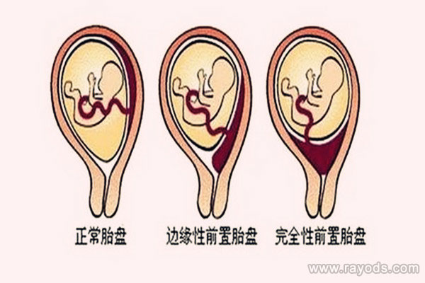 为什么男宝喜欢前壁 揭秘胎盘前壁男孩的真相