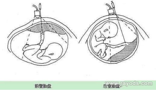 胎盘前壁和后壁的区别