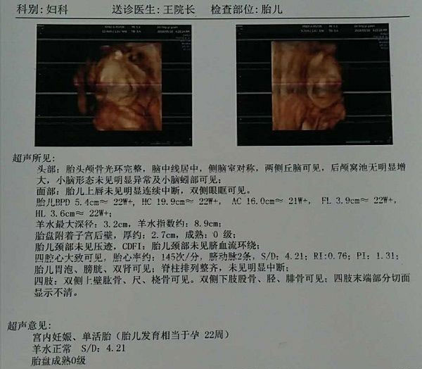 四维彩超检查